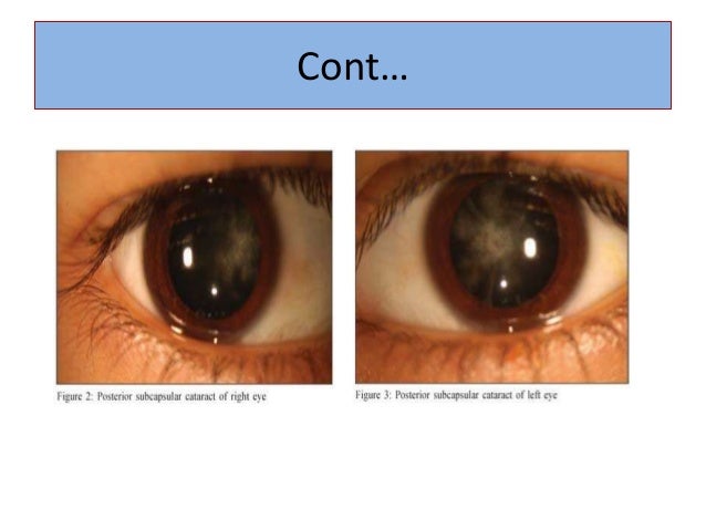 Pediatric Lens Diseases